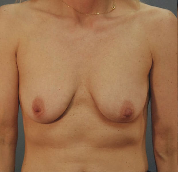 Breast Augmentation Patient Before 1