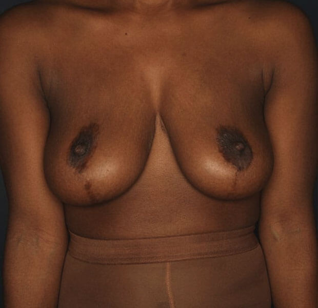 Breast Augmentation Patient Before 2