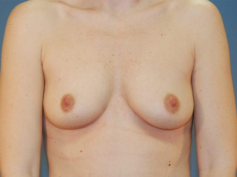 Breast Augmentation Patient Before 3