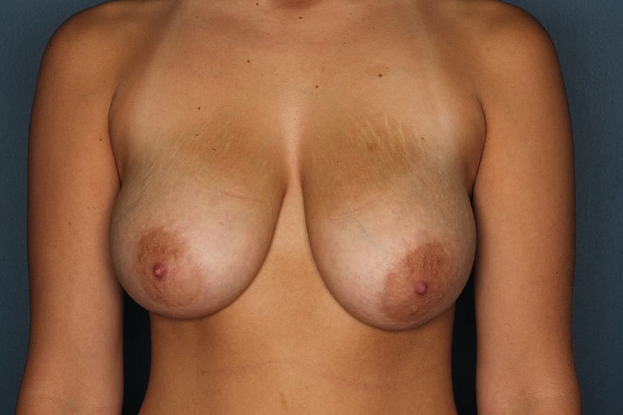 Breast lift patient before 2