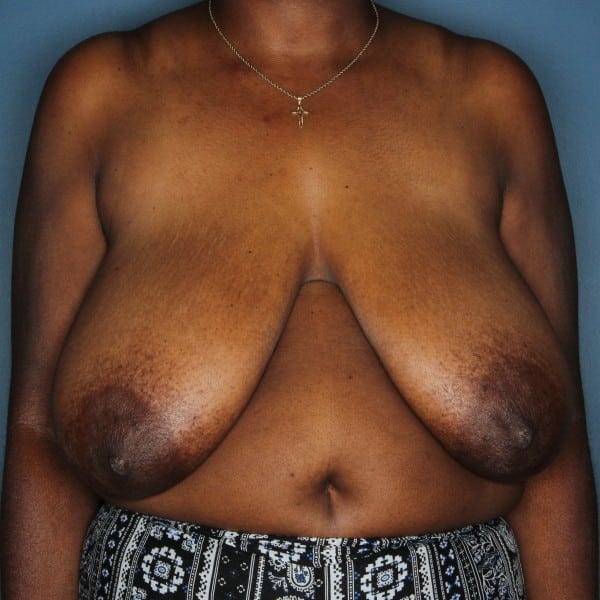 Breast reduction female patient before 2