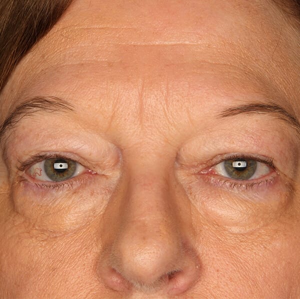 Eyelid lift patient before 1