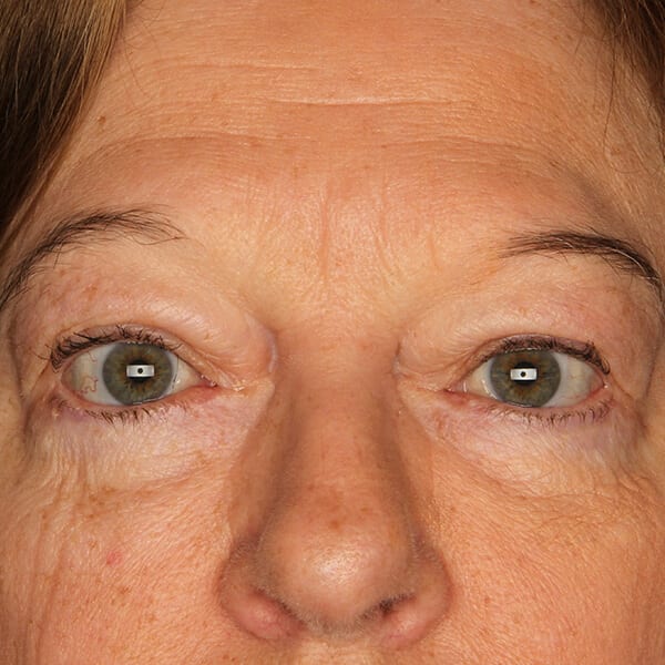 Eyelid lift patient after 1