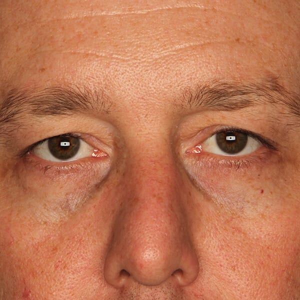 Eyelid lift patient before 2