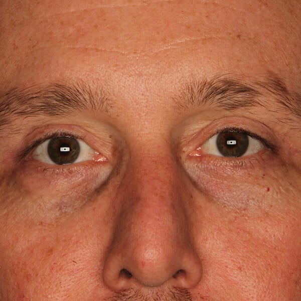 Eyelid lift patient after 2
