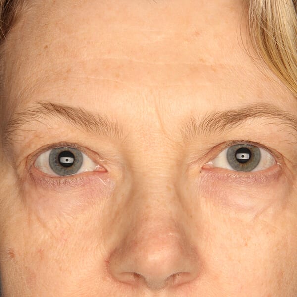 Eyelid lift patient before 3