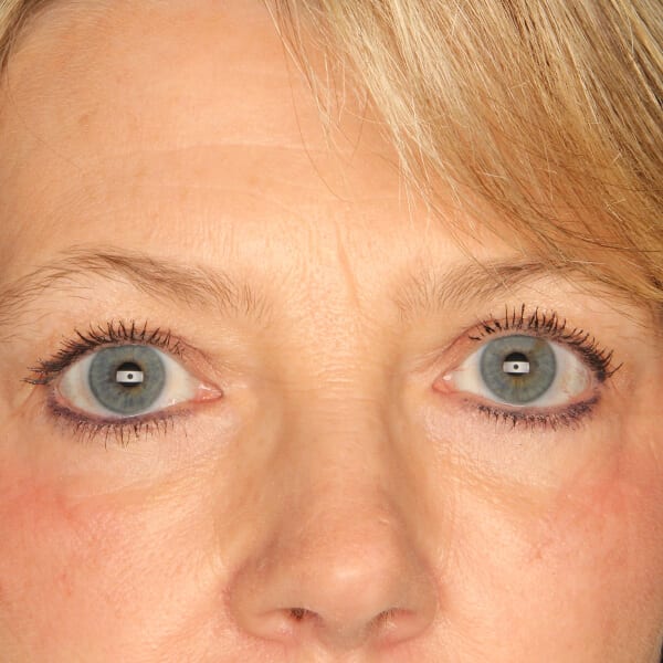 Eyelid lift patient after 3