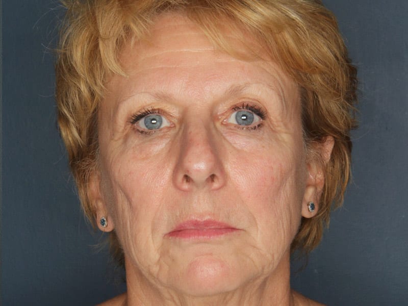 Facelift patient before 1