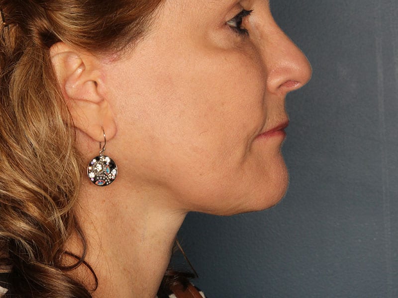 Facelift patient after 2