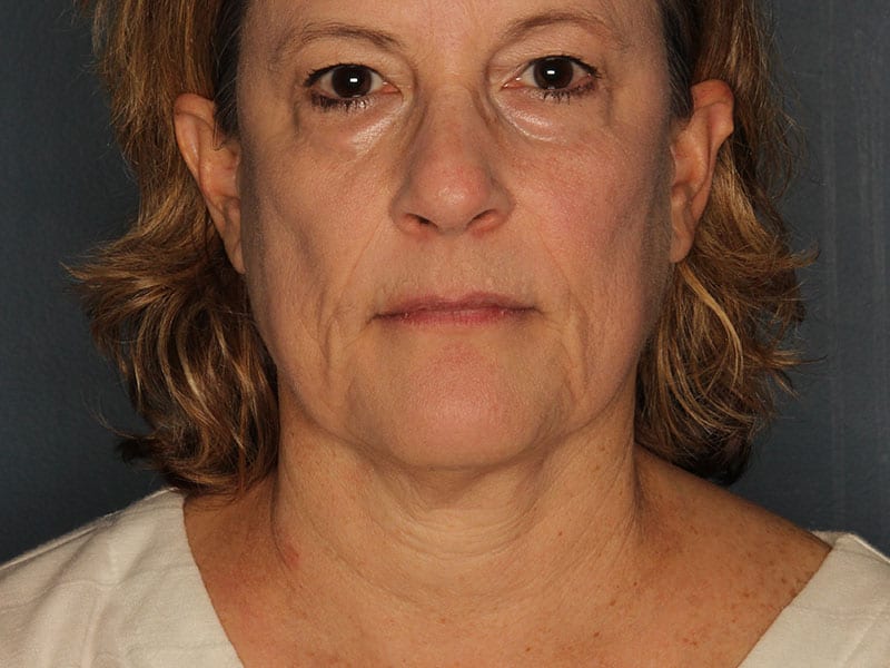 Facelift patient before 3