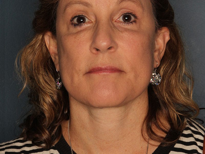 Facelift patient after 3