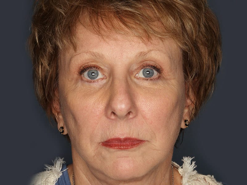 Facelift patient after 1