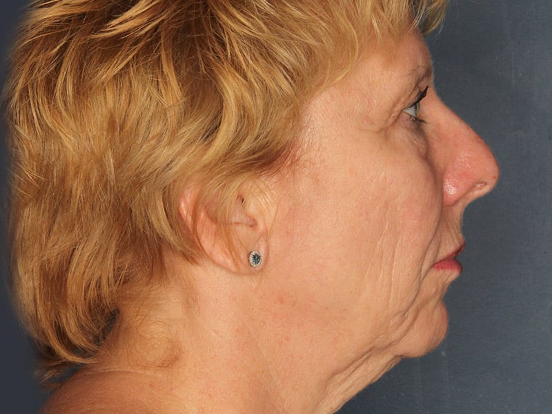 Facelift patient before 2