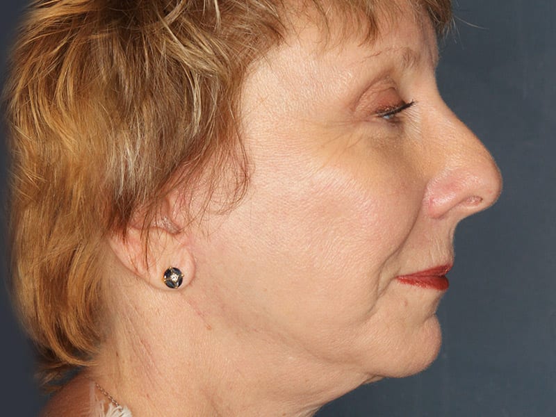 Facelift patient after 2