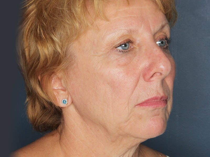 Facelift patient before 3