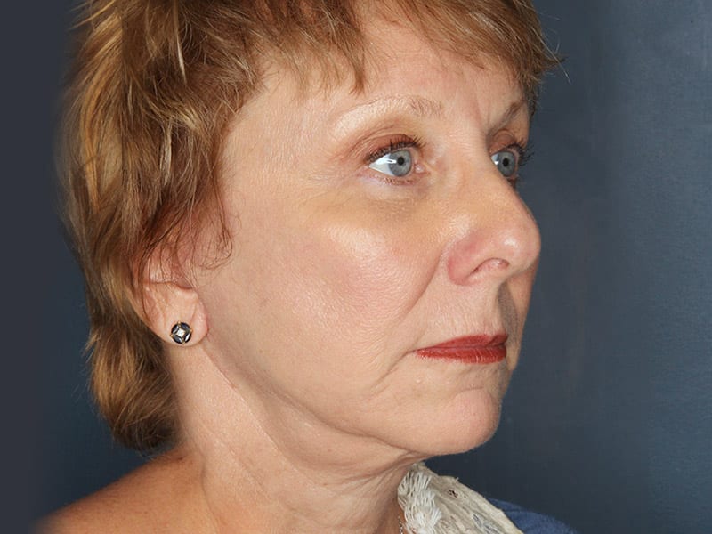 Facelift patient after 3