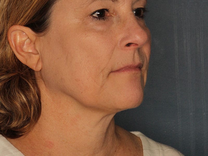 Facelift patient before 1
