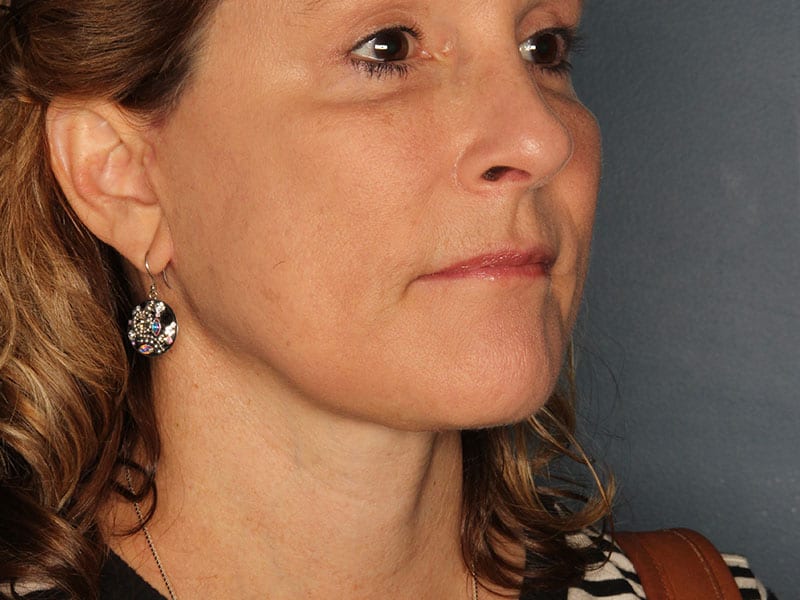 Facelift patient after 1