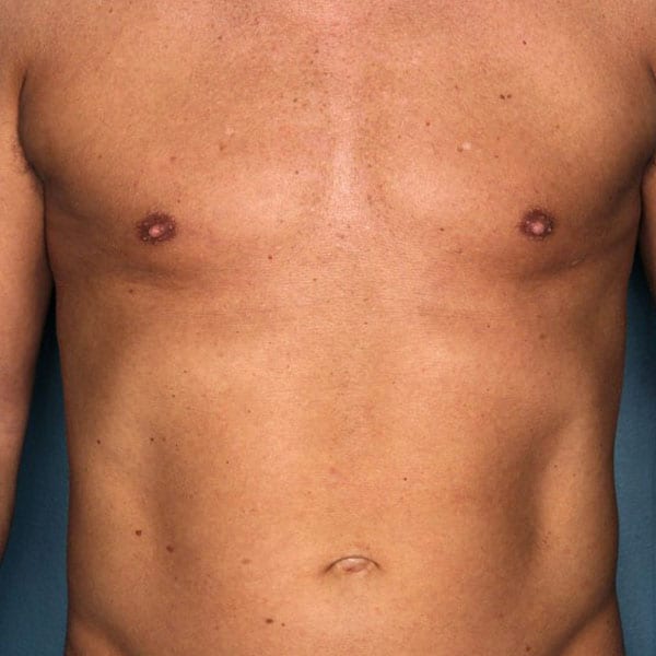 Liposuction patient after 1