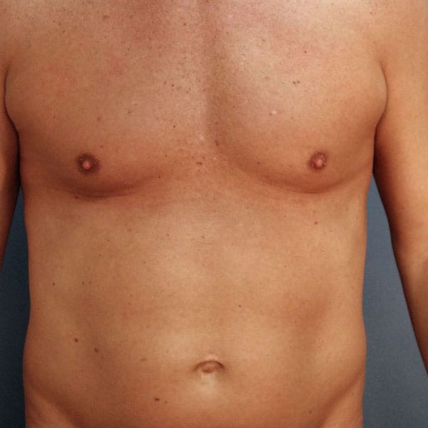 Liposuction patient before 1