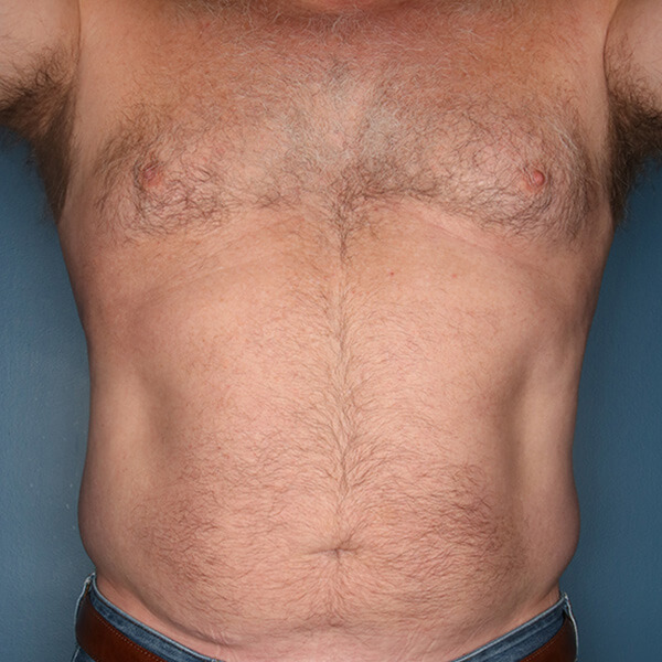 Liposuction patient before 2