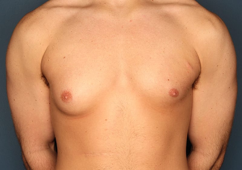 Breast reduction male patient before 1