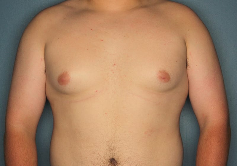Breast reduction male patient before 2