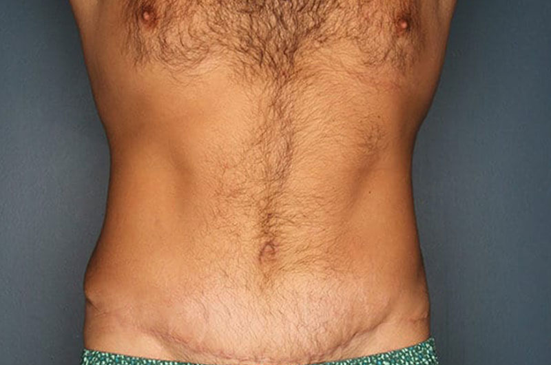 Tummy Tuck Patient After 1
