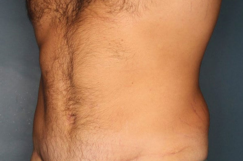 Tummy Tuck Patient After 2