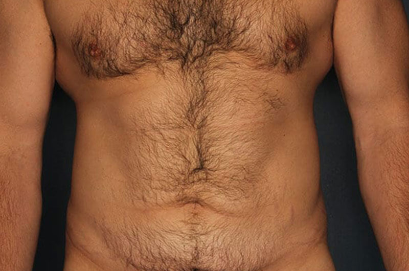 Tummy Tuck Patient Before 1