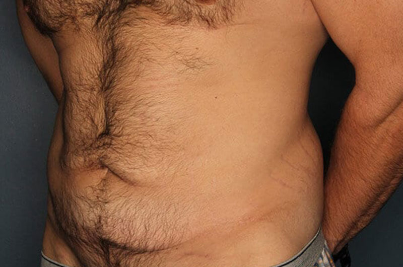 Tummy Tuck Patient Before 2