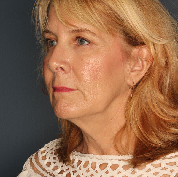 Neck lift patient before 1