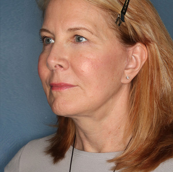 Neck lift patient after 1