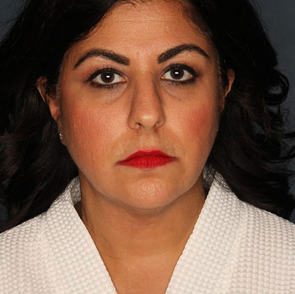Neck lift patient after 2