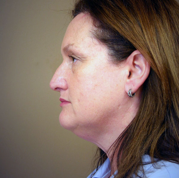 Neck lift patient before 3