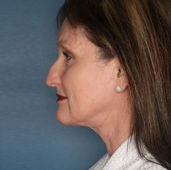 Neck lift patient after 3