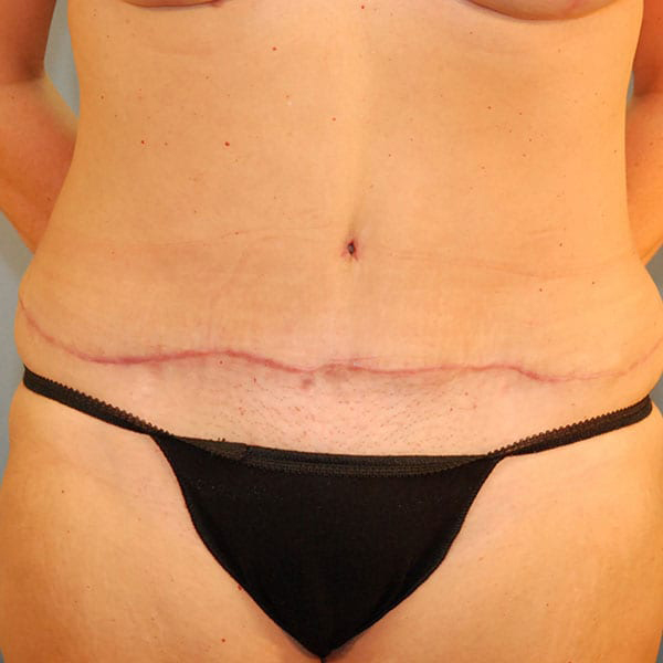 Breast Augmentation Patient After 3