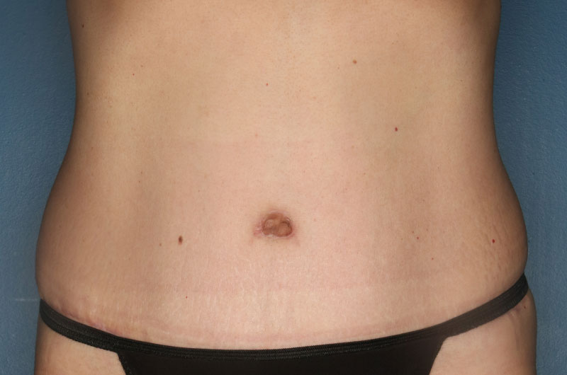 Tummy tuck patient after 2