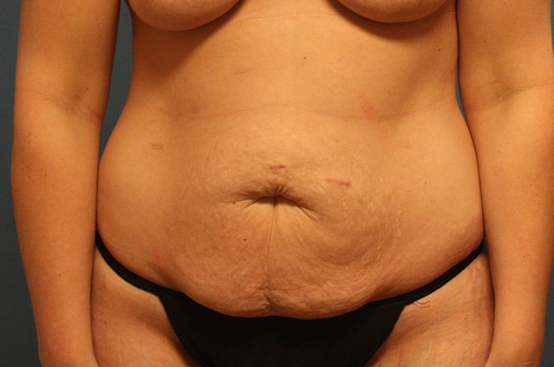 Tummy tuck patient before 1