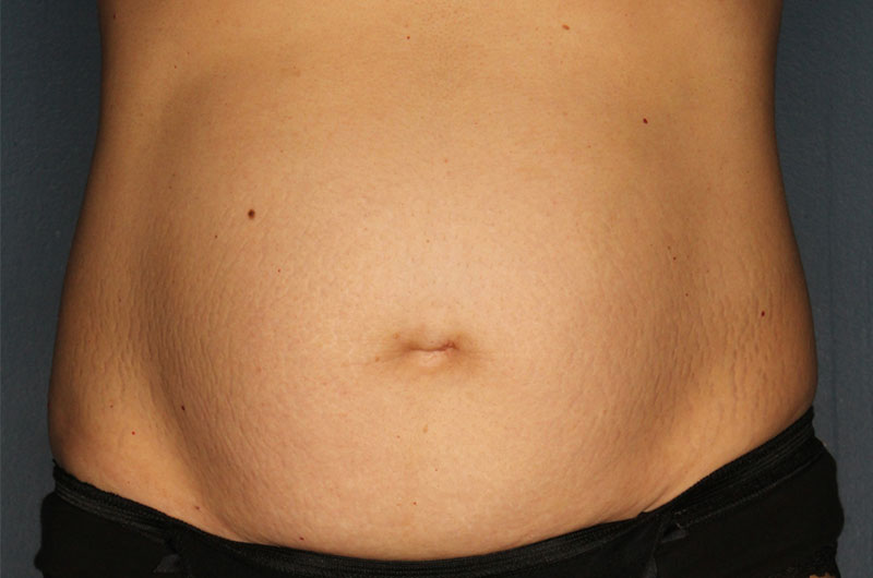 Tummy tuck patient before 2