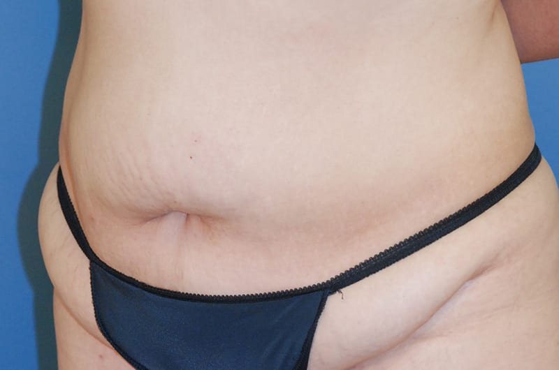 Tummy tuck patient before 3