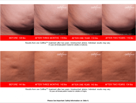 Smooth Away Cellulite Dimples: Cellfina™