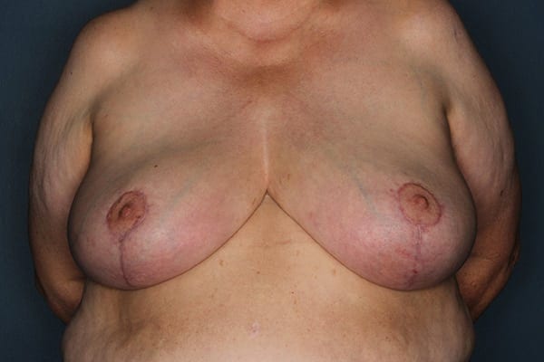 Breast Reduction Patient 05 After - 1