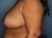 View Breast Reduction Patient 06 After - 2