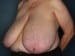 View Breast Reduction Patient 05 Before - 2