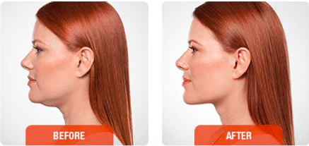 KYBELLA® Before and After