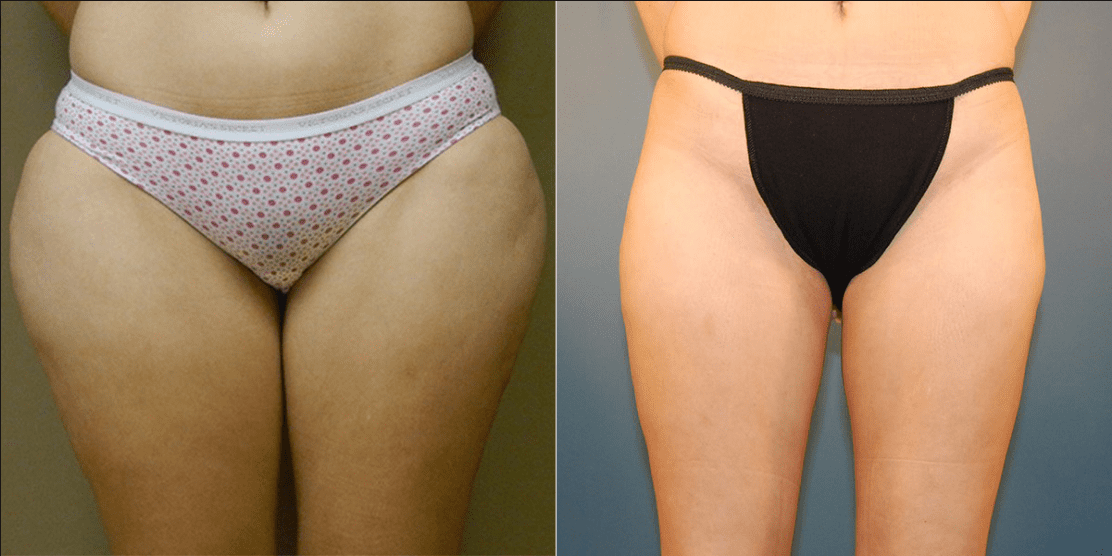 Will Liposuction Remove My Fat Forever?