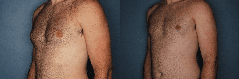 Before and After Gynecomastia Surgery