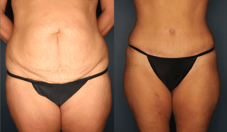 Before and After Abdominoplasty