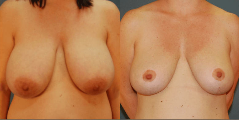 Before and After Breast Reduction